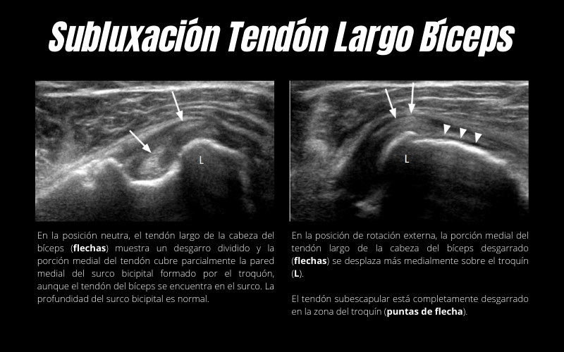 Subluxación Tendón Largo Bíceps Ecografía.png